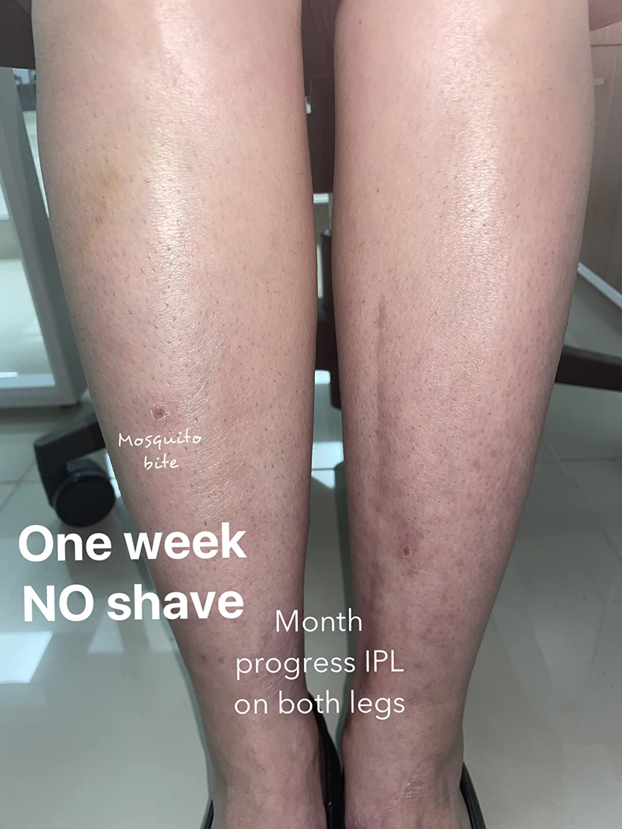 Braun IPL, Silk·Expert Pro 5, IPL Hair Removal for Women and Men, Permanent Laser Hair Reduction At-Home, 2 Heads, Pouch, Venus Razor, IPL5157 customer photo 2