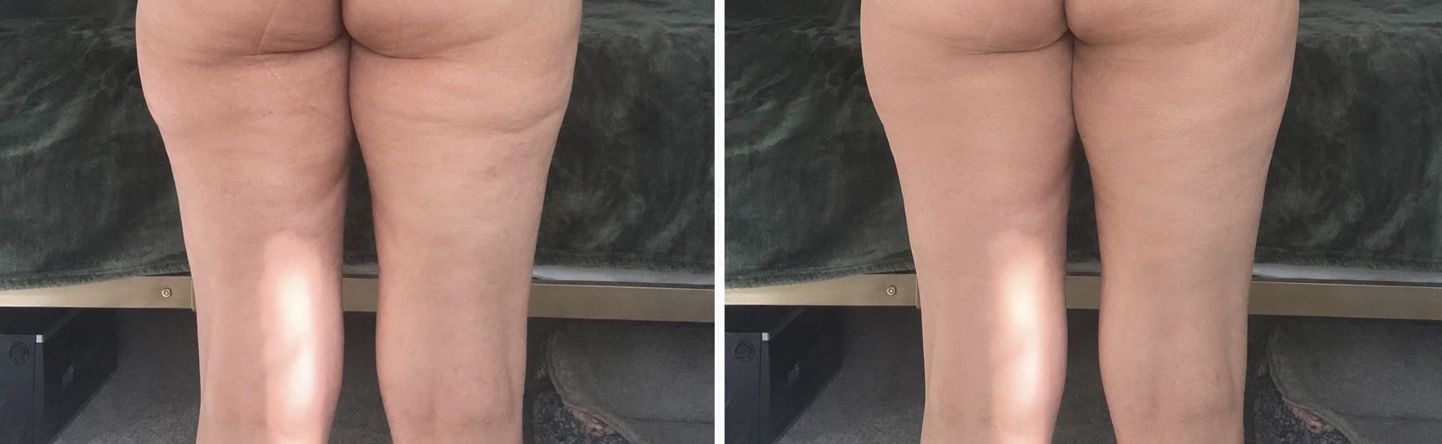 Radio Frequency Induced Heat-Palm NRG Cellulite Body Device customer photo 2